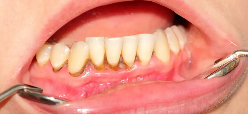 كيف يتكون جير الأسنان 